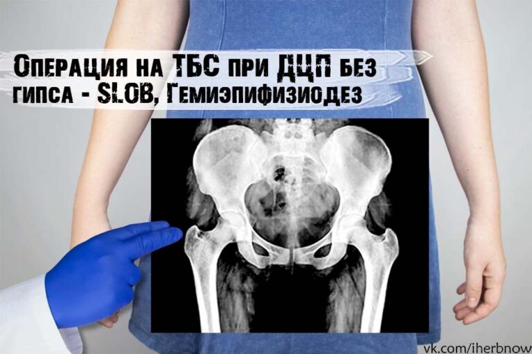 Подробнее о статье Сравнение остеотомии, SLOB и Guided Growth при подвывихе для ДЦП